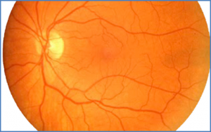 Understanding the genetic architecture of human retinal degenerations