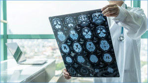 Scientists Identify Protein Target for Alzheimer`s Treatment